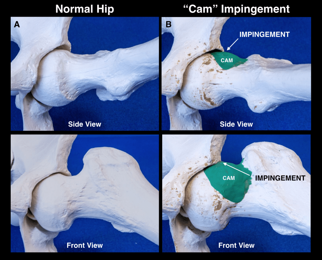 Figure 2 1024x827 - Hip Impingement