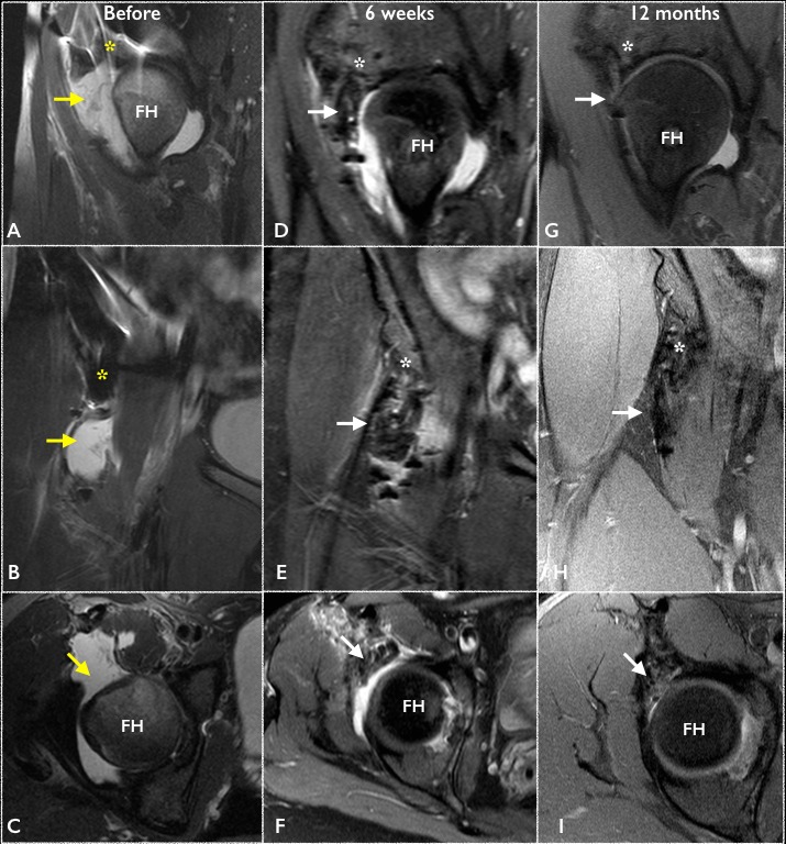 Figure 2 Revised - New Cutting-Edge Arthroscopic Procedure to Treat Recurrent Hip Instability With Capsular Deficiency