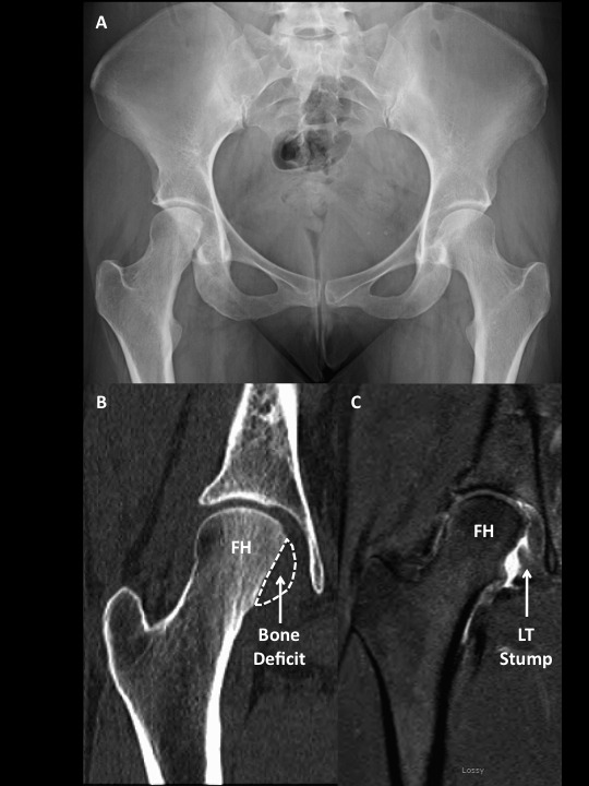 Figure 1 LT Recon - All Arthroscopic Ligamentum Teres (LT) Reconstruction of the Hip