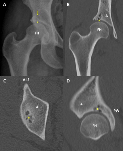 Figure 1 - Bone Cysts in the Hip Socket: Treatment with Arthroscopic Bone Grafting