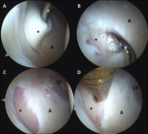 Figure 2 - Bone Cysts in the Hip Socket: Treatment with Arthroscopic Bone Grafting