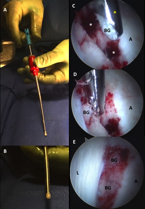 Figure 3 - Bone Cysts in the Hip Socket: Treatment with Arthroscopic Bone Grafting