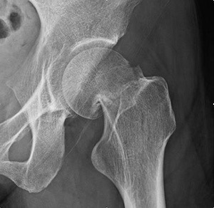 Hip Fracture Image - Displaced Hip Fracture in a 50 Year-Old Active Patient: A Challenging Problem