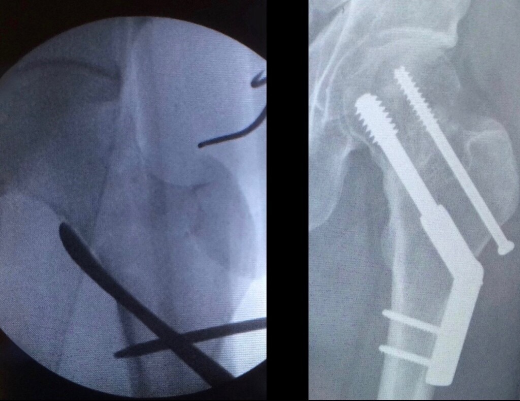 ORIF 1024x789 - Displaced Hip Fracture in a 50 Year-Old Active Patient: A Challenging Problem