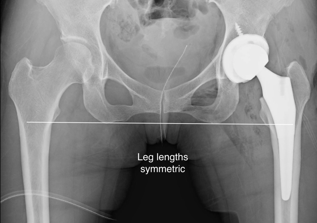 Post Op 1024x721 - Displaced Hip Fracture in a 50 Year-Old Active Patient: A Challenging Problem