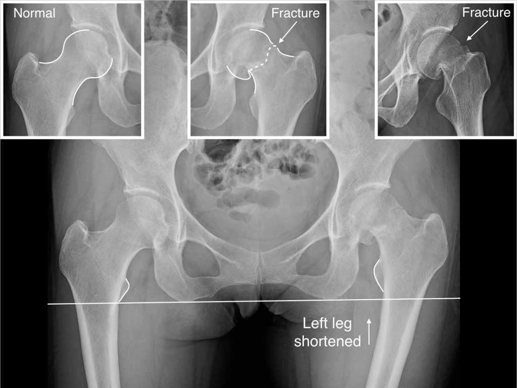 Pre Op 1024x768 - Displaced Hip Fracture in a 50 Year-Old Active Patient: A Challenging Problem