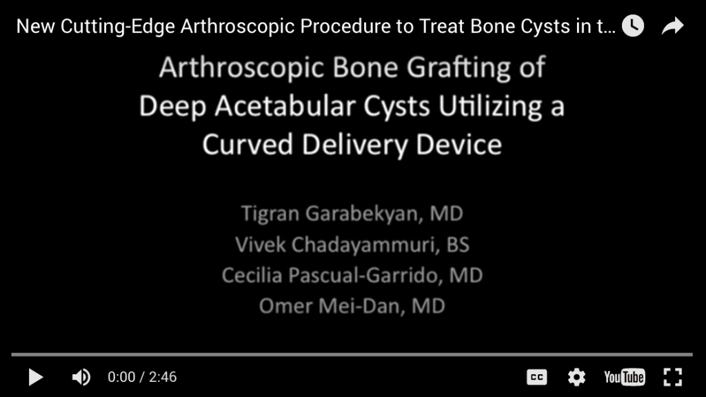 Screen Shot 2016 05 18 at 3.22.32 PM 1024x576 - Bone Cysts in the Hip Socket: Treatment with Arthroscopic Bone Grafting