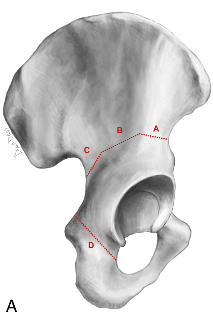 Figure 1A 682x1024 - The Birmingham Interlocking Pelvic Osteotomy for Acetabular Dysplasia: 13- to 21- year Survival Outcomes
