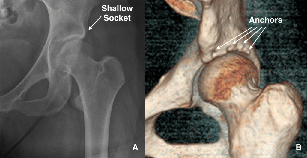 Figure 1 1024x529 - Hip Arthroscopy vs Periacetabular Osteotomy (PAO):  What Is The Best Treatment for Hip Dysplasia?  A Case Example