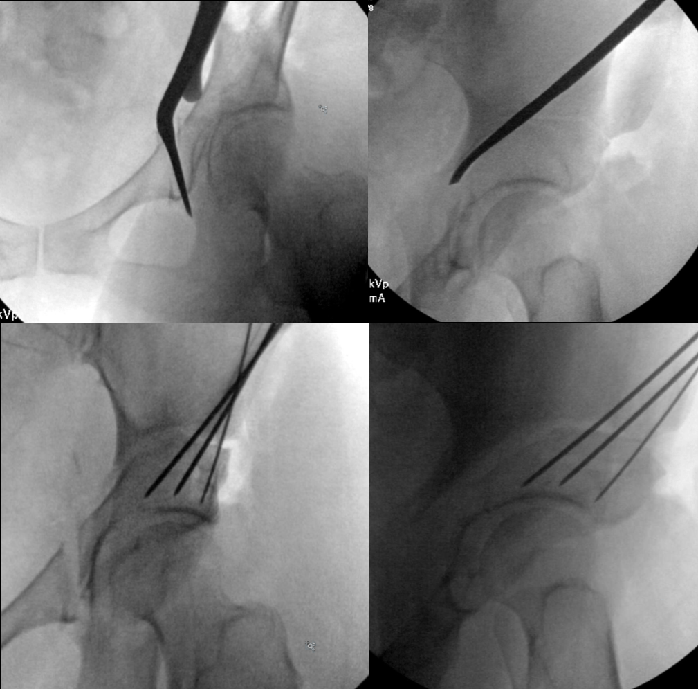 Figure 2 - Hip Arthroscopy vs Periacetabular Osteotomy (PAO):  What Is The Best Treatment for Hip Dysplasia?  A Case Example