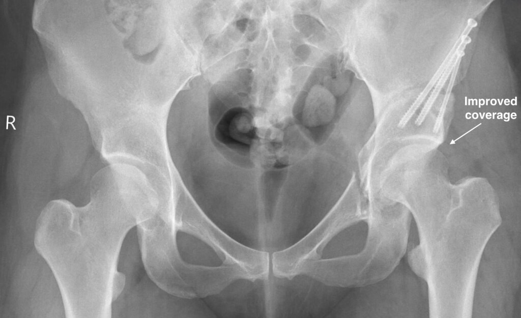 Figure 3 1024x625 - Hip Arthroscopy vs Periacetabular Osteotomy (PAO):  What Is The Best Treatment for Hip Dysplasia?  A Case Example