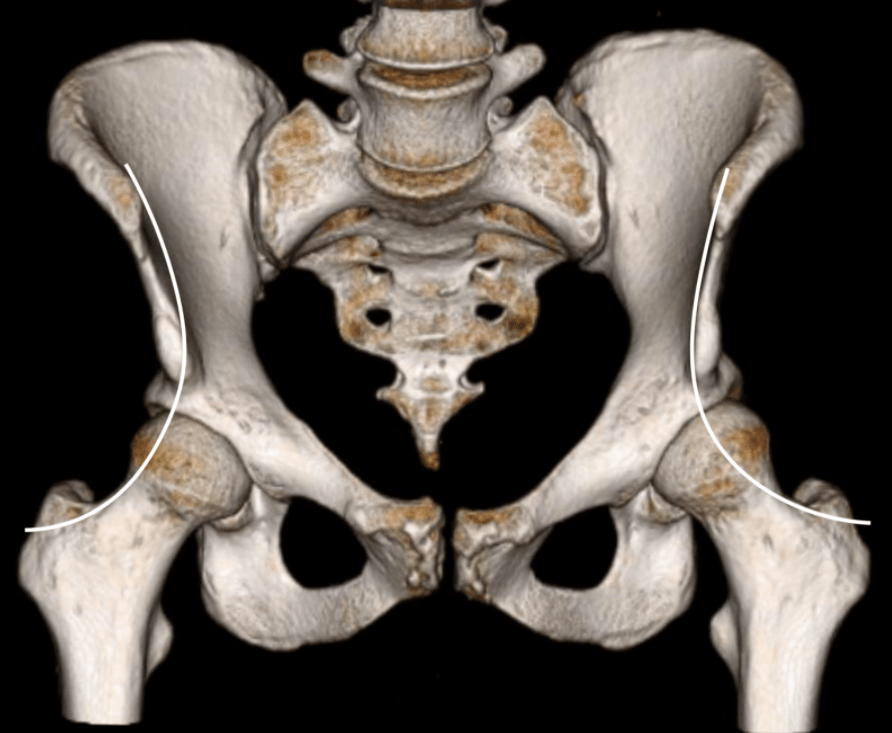 Figure 2 - The Iliofemoral Line : A Radiographic Sign of Acetabular Dysplasia in the Adult Hip