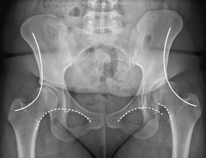 Figure 3 1 - The Iliofemoral Line : A Radiographic Sign of Acetabular Dysplasia in the Adult Hip
