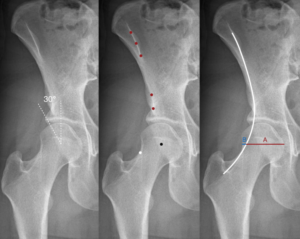 figure 1 - The Iliofemoral Line : A Radiographic Sign of Acetabular Dysplasia in the Adult Hip