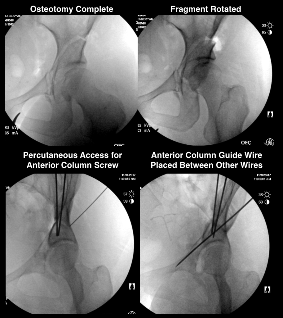 Figure 3 913x1024 - Improving Bony Stability following PAO Surgery