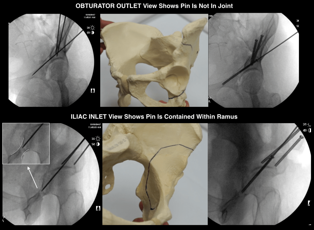 Figure 4 1024x751 - Improving Bony Stability following PAO Surgery