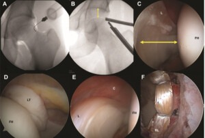 Anteroposterior fluoroscopic image 300x202 - Hip Distraction without a Perineal Post: A Study of 1000 Hip Arthroscopy Cases