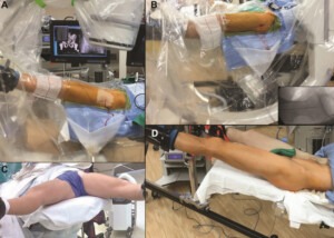 obtaining an anteroposterior fluoroscopic 300x214 - Hip Distraction without a Perineal Post: A Study of 1000 Hip Arthroscopy Cases