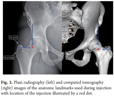 radiography - Study Shows Efficacy of Non-Image-Guided Diagnostic Hip Injections