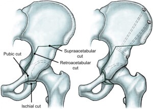 Periacetabular Osteotomy 300x214 - Periacetabular Osteotomy