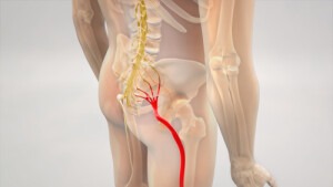 What Can You Do To Treat Sciatica Pain 300x169 - What Can You Do To Treat Sciatica Pain?