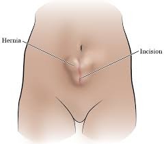 Hernia Causes And Treatment - Hernia Causes And Treatment