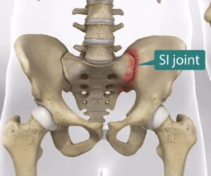 SI Joint Problems And Treatment 300x250 - SI Joint Problems And Treatment