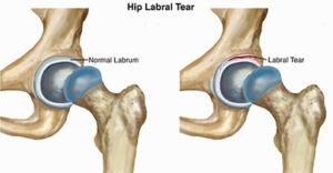 Labral Hip Tear Treatment Los Angeles Beverly Hills Santa Monica CA 300x156 - Labral Hip Tear Treatment