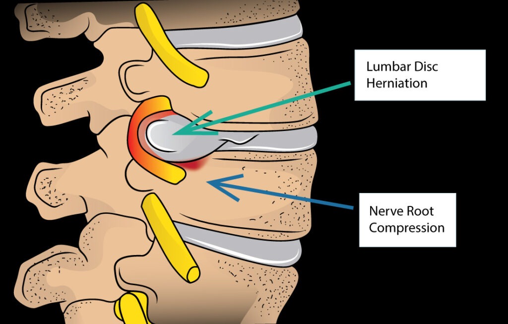 Lumbar Disc Herniation Treatment Los Angeles, Beverly Hills, Santa
