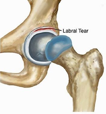 labral tear - Labral Tear Caused By Repetitive Motions