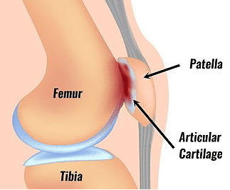 Patellofemoral Pain Syndrome - Can Patellofemoral Pain Syndrome (PFPS) Cause Hip Pain?