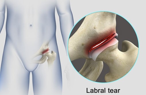 Torn Labrum In Your Hip - How Do You Know If You Have A Torn Labrum In Your Hip?